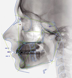 Cephalometric Analysis ソフトウエア