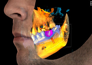 3 X 3D = CBCT + ProFace + 印象スキャン