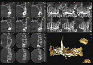 高画質の歯内イメージング
