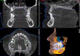 3 x 3D = CBCT + Pro Face + 印象スキャン