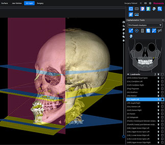 Romexis® 3D Cephalometry正確な3D分析 Romexis® 3D Cephalometry正確な3D分析