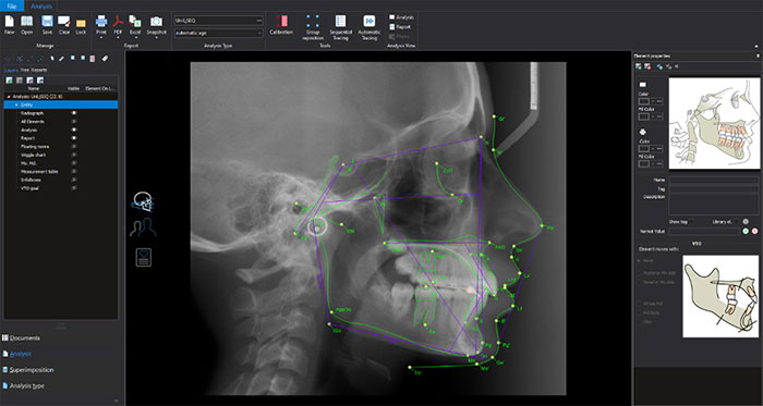 Romexis® Cephalometric Analysis