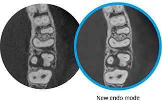 最先端の歯内画像撮影
