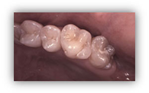 充填物や補綴物など歯牙の状態や全体的な歯の衛生状態を確認するための歯牙画像