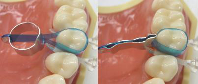 ルシフィックス マトリックスバンド カボデンタルシステムズ株式会社 Kavo Dental Systems