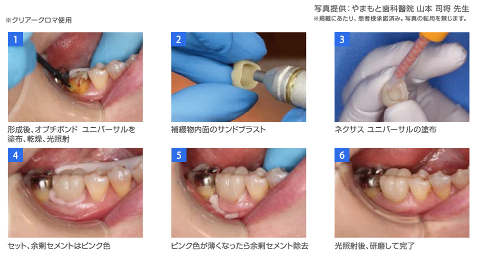 保険CAD/CAM冠の接着画像 ※クリア―クロマ使用 1.形成後、オプチボンド ユニバーサルを塗布、乾燥、光照射 2.補綴物内面のサンドブラスト 3.ネクサス ユニバーサルの塗布 4.セット、余剰セメントはピンク色 5.ピンク色が薄くなったら余剰セメント除去 6.光照射後、研磨して完了