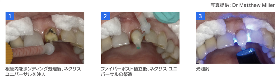 コア築造 1.根管内をボンディング処理後、ネクサスユニバーサルを注入 2.ファイバーポスト植立後、ネクサス ユニバーサルの築造 3.光照射